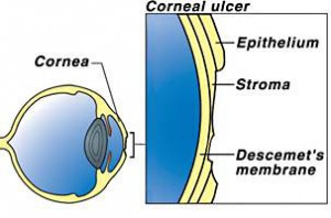 Corneal_Ulcer_contact lenses