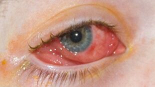 Eye Redness