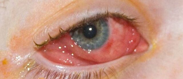 Eye Redness